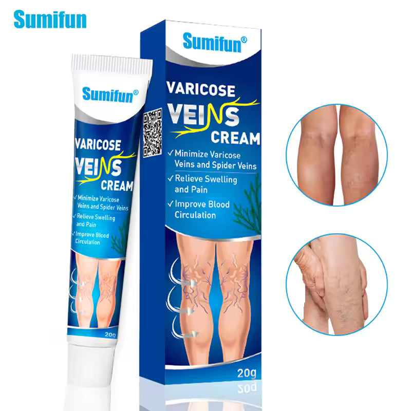 Varicose Veins Treatment for Legs