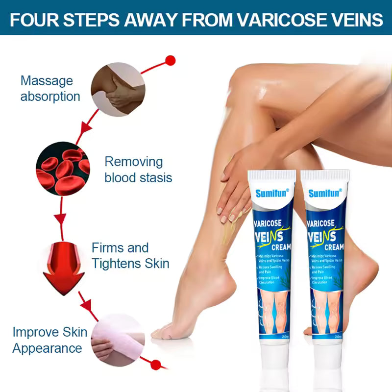 Varicose Veins Treatment for Legs