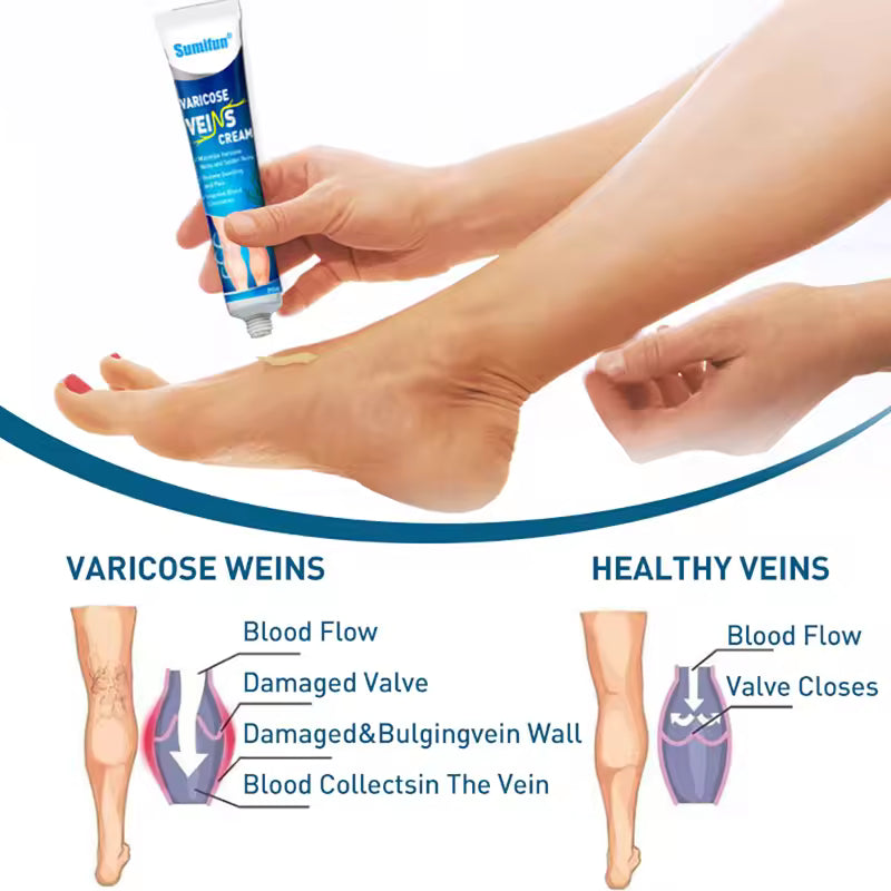 Varicose Veins Treatment for Legs